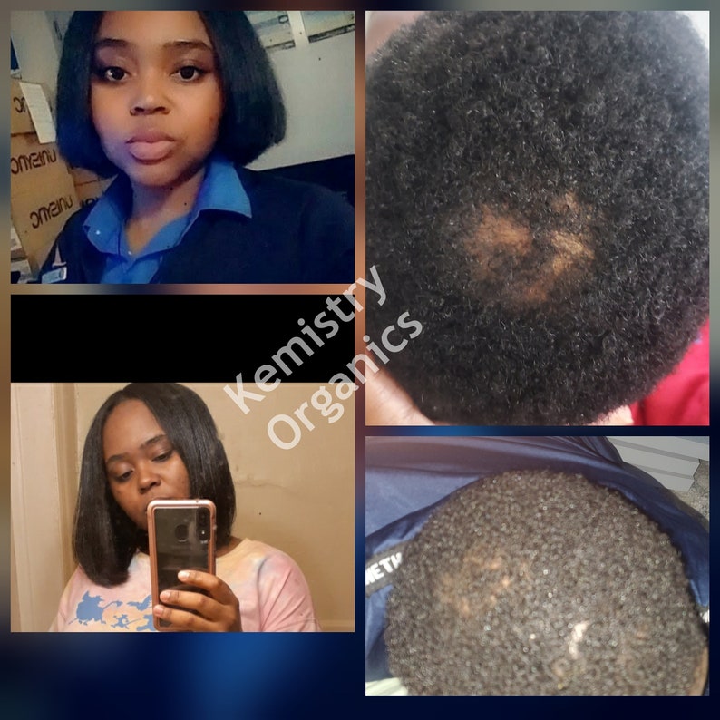 before and after bald spots dht alopecia