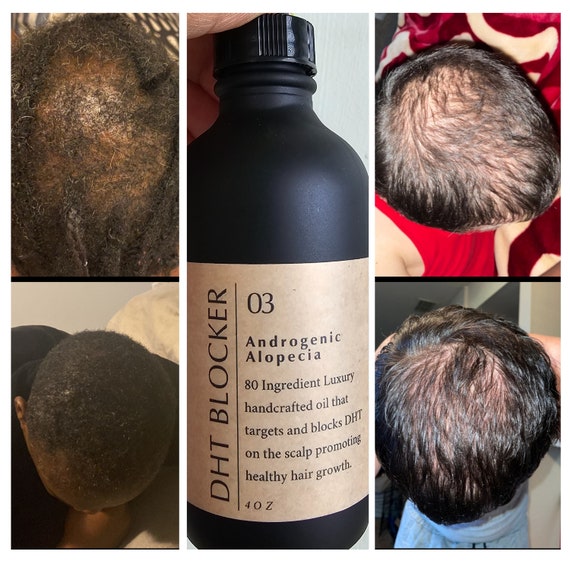 Hairloss blocker 2024