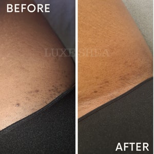 May include: Before and after photos demonstrating the effectiveness of a skincare product. The before photo shows dark marks and stretch marks on the skin. The after photo shows the skin appearing smoother and brighter.