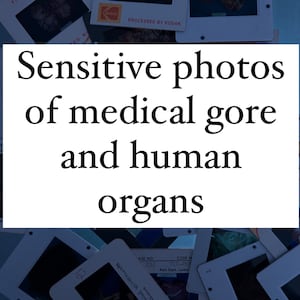 May include: A collection of Kodachrome slides with medical imagery. The slides, labelled with text, depict what seems to be human organs. The image text reads "Sensitive photos of medical gore and human organs."