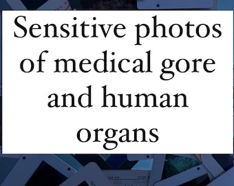 Cinco diapositivas médicas antiguas al azar de órganos humanos y tejido enfermo, rarezas médicas, sangre médica, anatomía, diapositivas de fotos antiguas