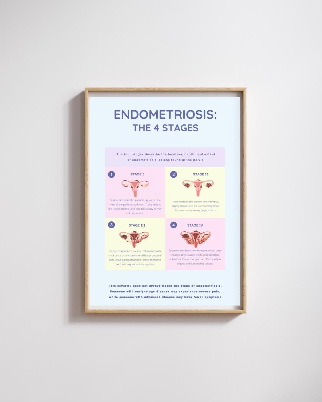 Endometriosis Stages Poster | Endometriosis Education Printable ...