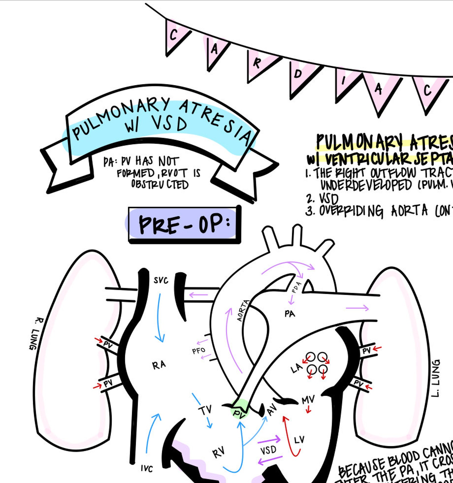 Pulmonary Atresia pre/post Op and PS Overview Nicu Nursing Etsy