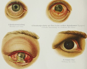 1897 Antique bizarre lithograph of OPHTHALMOLOGY: HUMAN EYES. Eyeball. Surgery. Anatomy. Medicine. Doctor gift. 127 years old print.