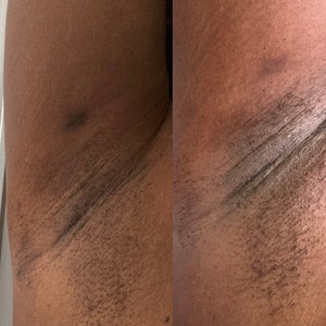 Peut inclure: Gros plan de deux images montrant la m&ecirc;me zone de peau, avant et apr&egrave;s traitement. L'image avant montre une peau plus fonc&eacute;e avec une hyperpigmentation visible. L'image apr&egrave;s montre une peau plus claire avec un teint plus uniforme.