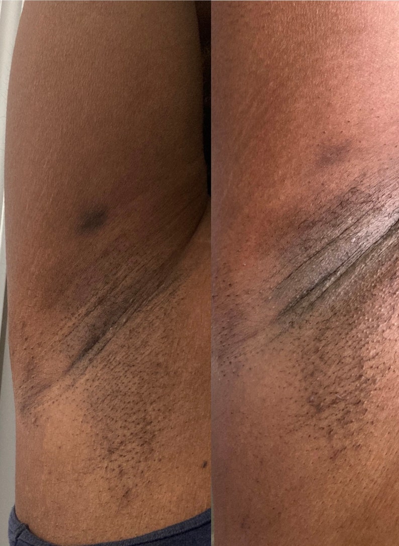 Peut inclure: Gros plan de deux images montrant la m&ecirc;me zone de peau, avant et apr&egrave;s traitement. L'image avant montre une peau plus fonc&eacute;e avec une hyperpigmentation visible. L'image apr&egrave;s montre une peau plus claire avec un teint plus uniforme.