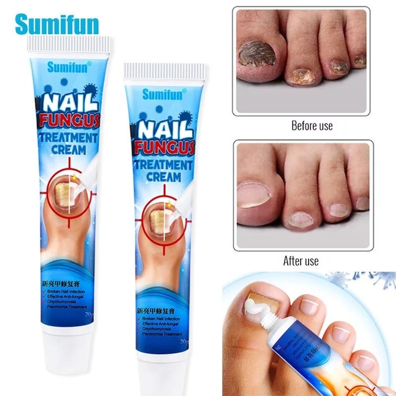Chinese Herbal Toe Nail Fungus Treatment Cream Onychomycosis Etsy