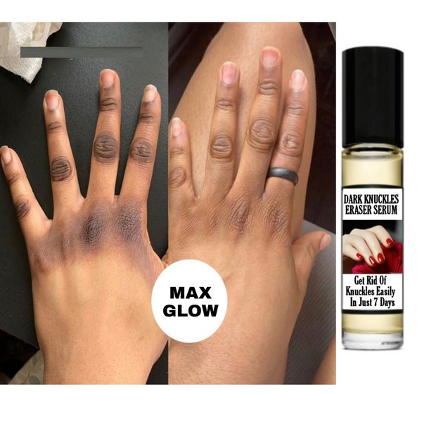 Dark Knuckles remover serum,  strong effective knuckles remover,  removes dark spots