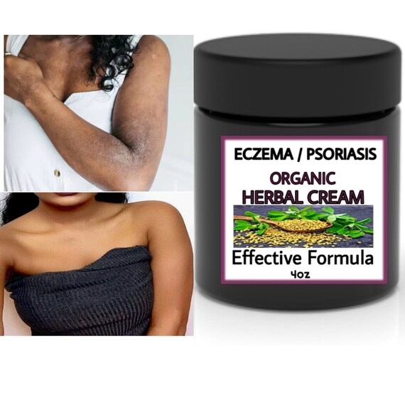 Super Effective Eczema Cream Dry Skin Itchy Skin Etsy