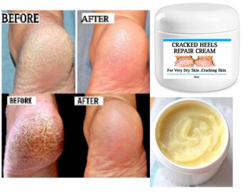 Cracked heels balm , Very dry skin