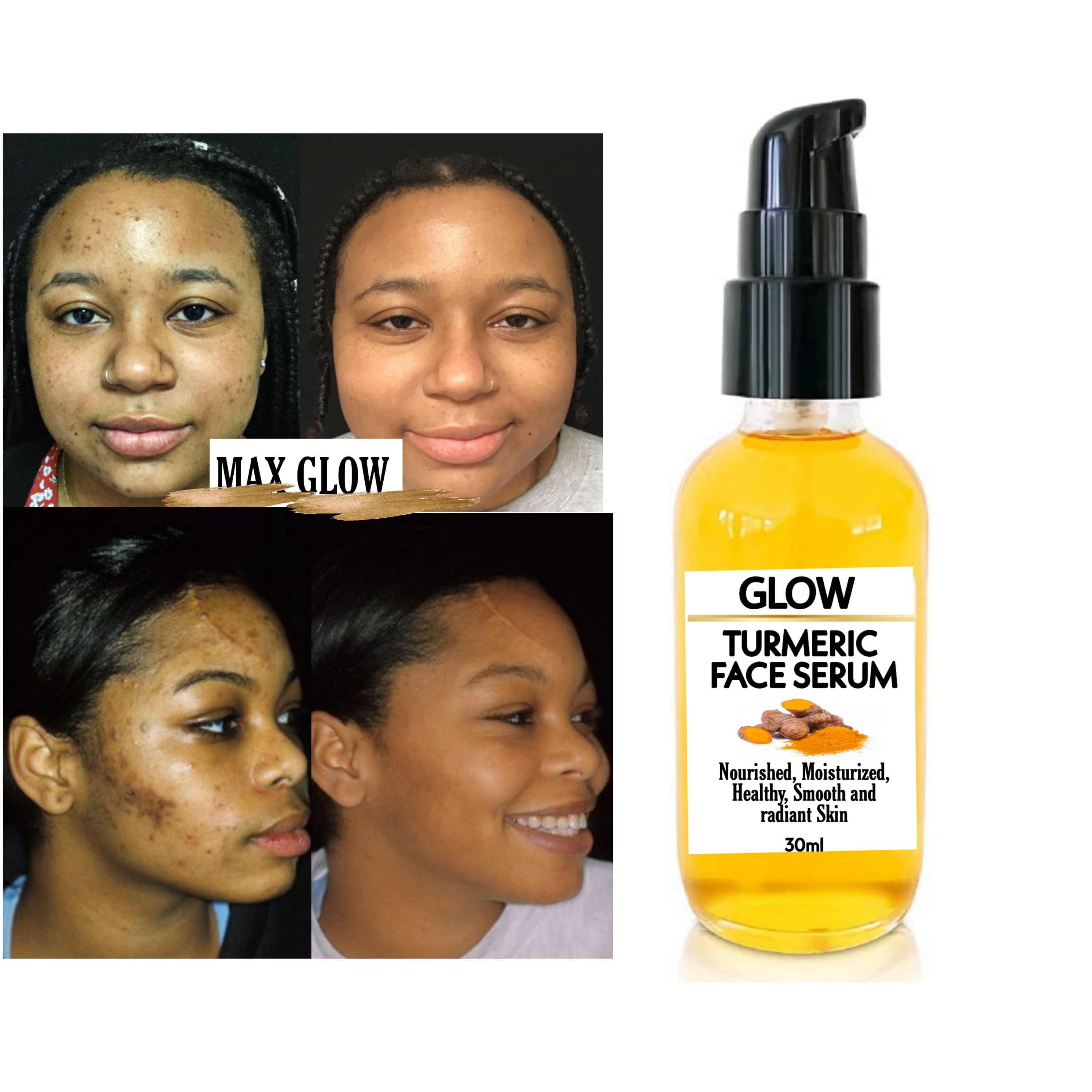 Turmeric Serum Dark Spots Eraser Spotless Skin Etsy