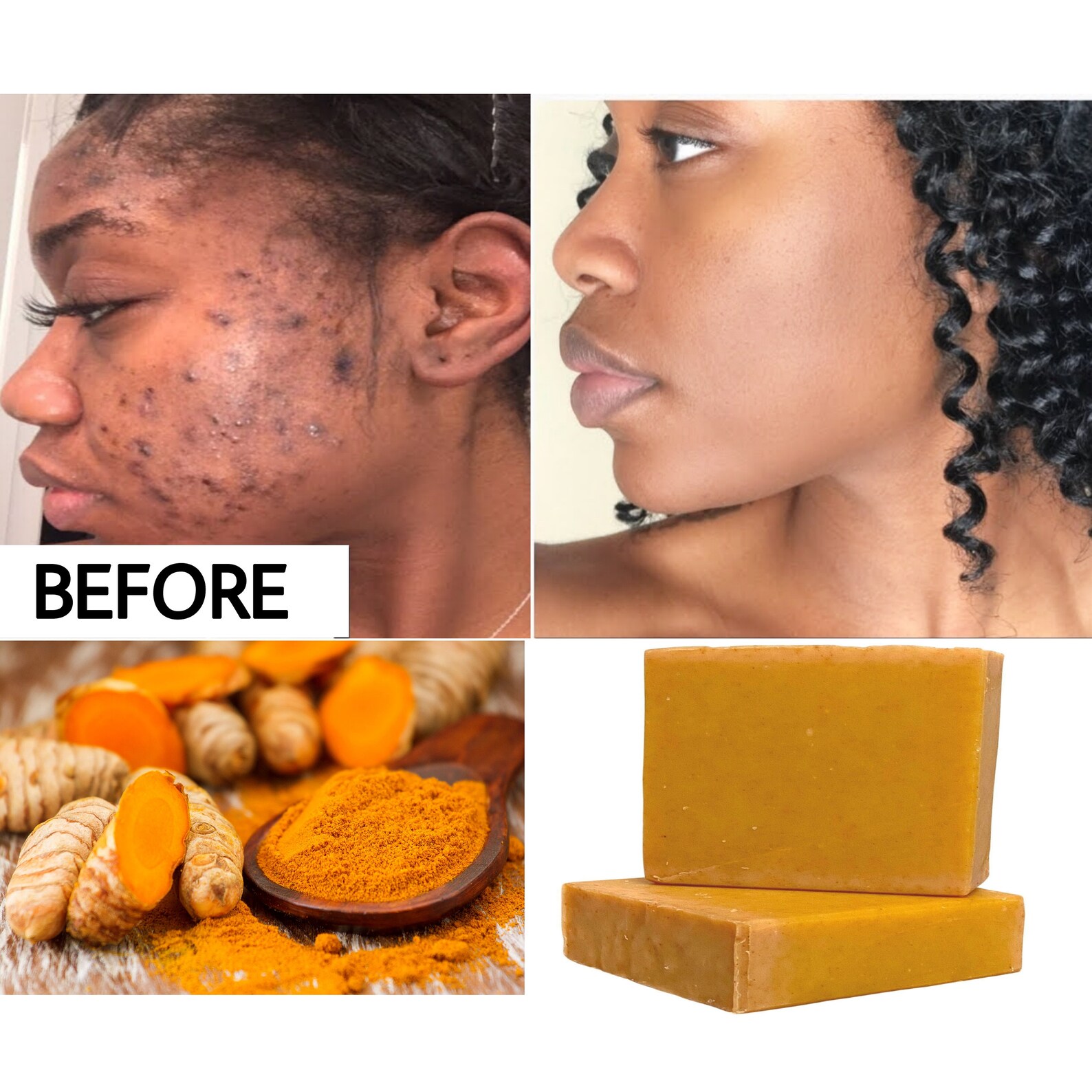 Tumeric Kojic Soap Dark Spots Remover Even Skin Tone Etsy