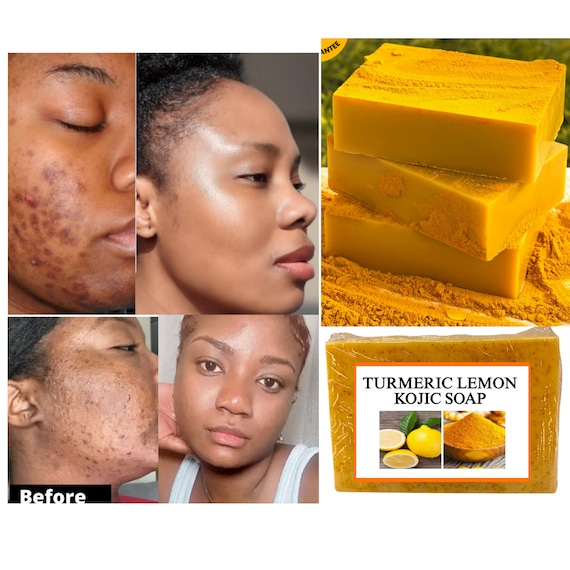 Turmeric Lemon Kojic Soap Glowing Skin Best Soap Ever Etsy