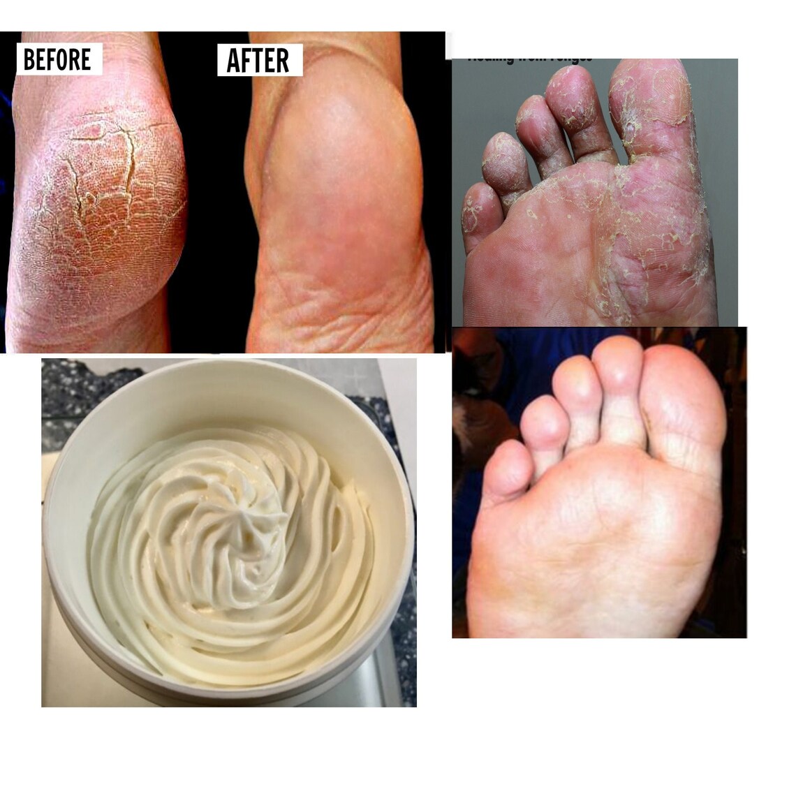 Cracked Dry Heels Feet Athlete Feet Repair Cream rough Dry Etsy Canada