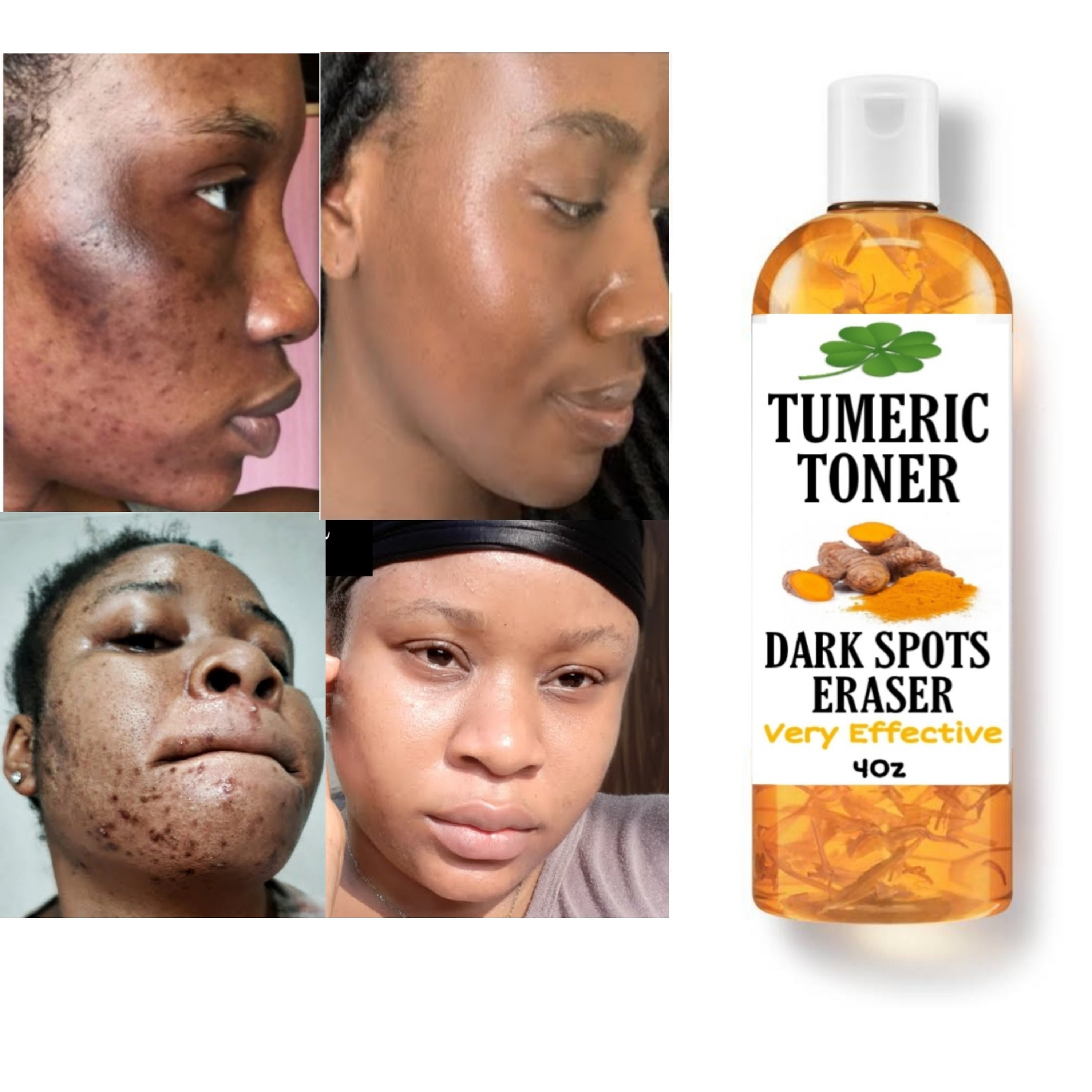 Tumeric Dark Spots Toner Dark Spots Eraser Even Skin Tone Etsy