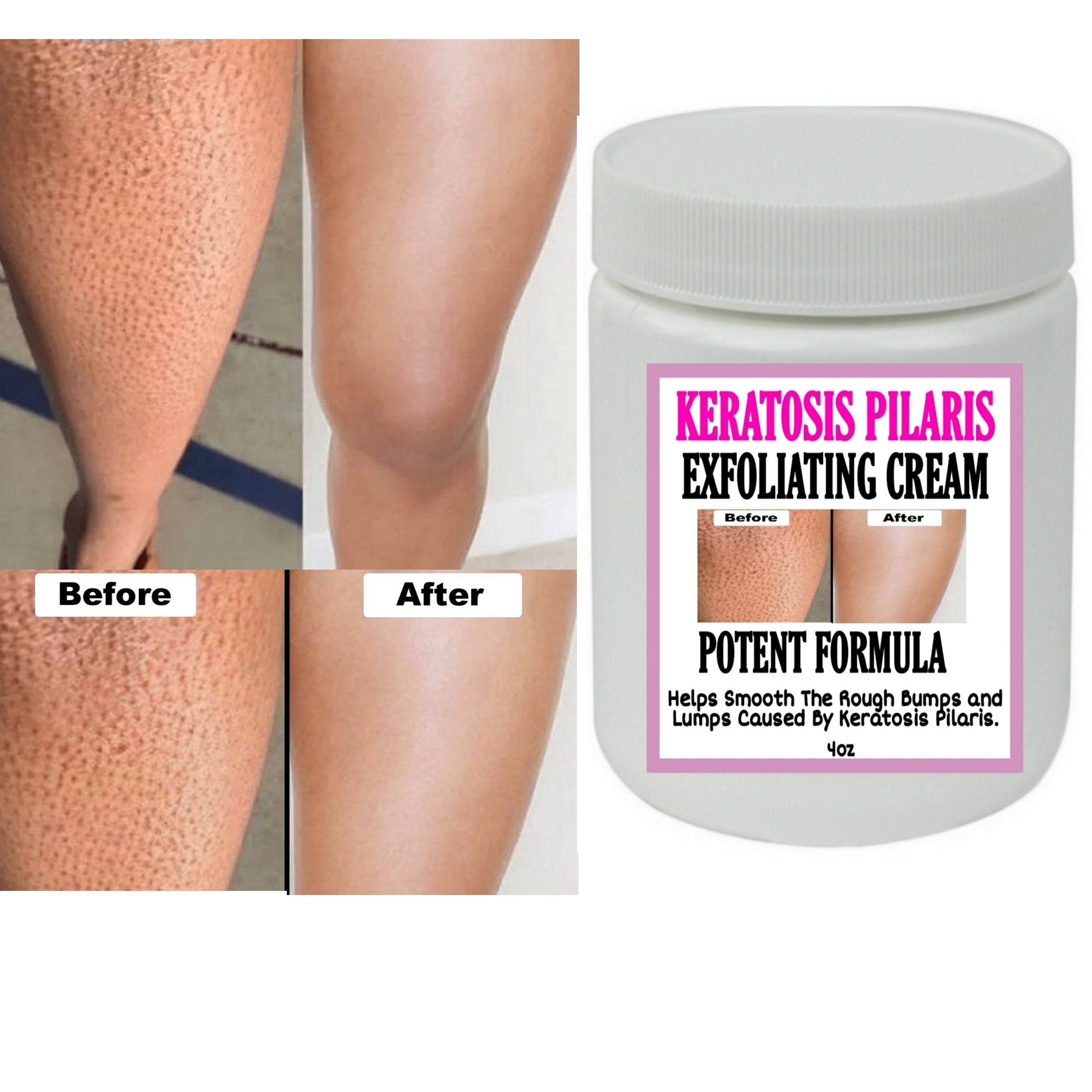 Strawberry Legs Exfoliating Cream Potent Formula Etsy UK