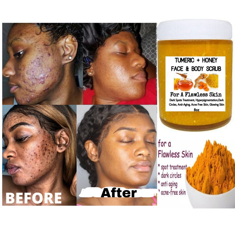 Turmeric Scrub Acne Dark Spots Eraser Even Skin Tone Etsy