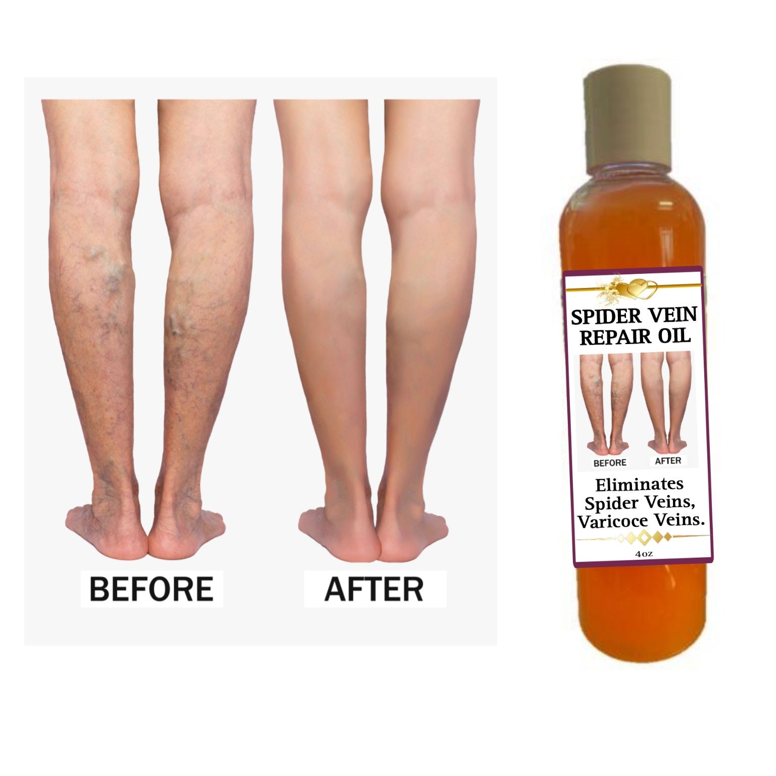 Spider Vein Oil - Etsy