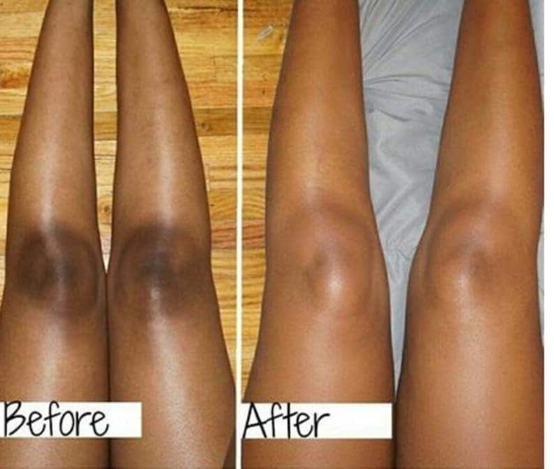 INTENSE BRIGHTENING, Knee, Feet, Elbows Cream, Very Effective, It Works image 2