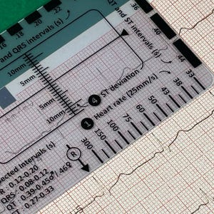 May include: A clear plastic ruler with black markings for measuring heart rate and ST deviation on an electrocardiogram (ECG). The ruler has numbers from 30 to 300, 75 to 100, and 150. The ruler also has markings for QRS and ST intervals in seconds.