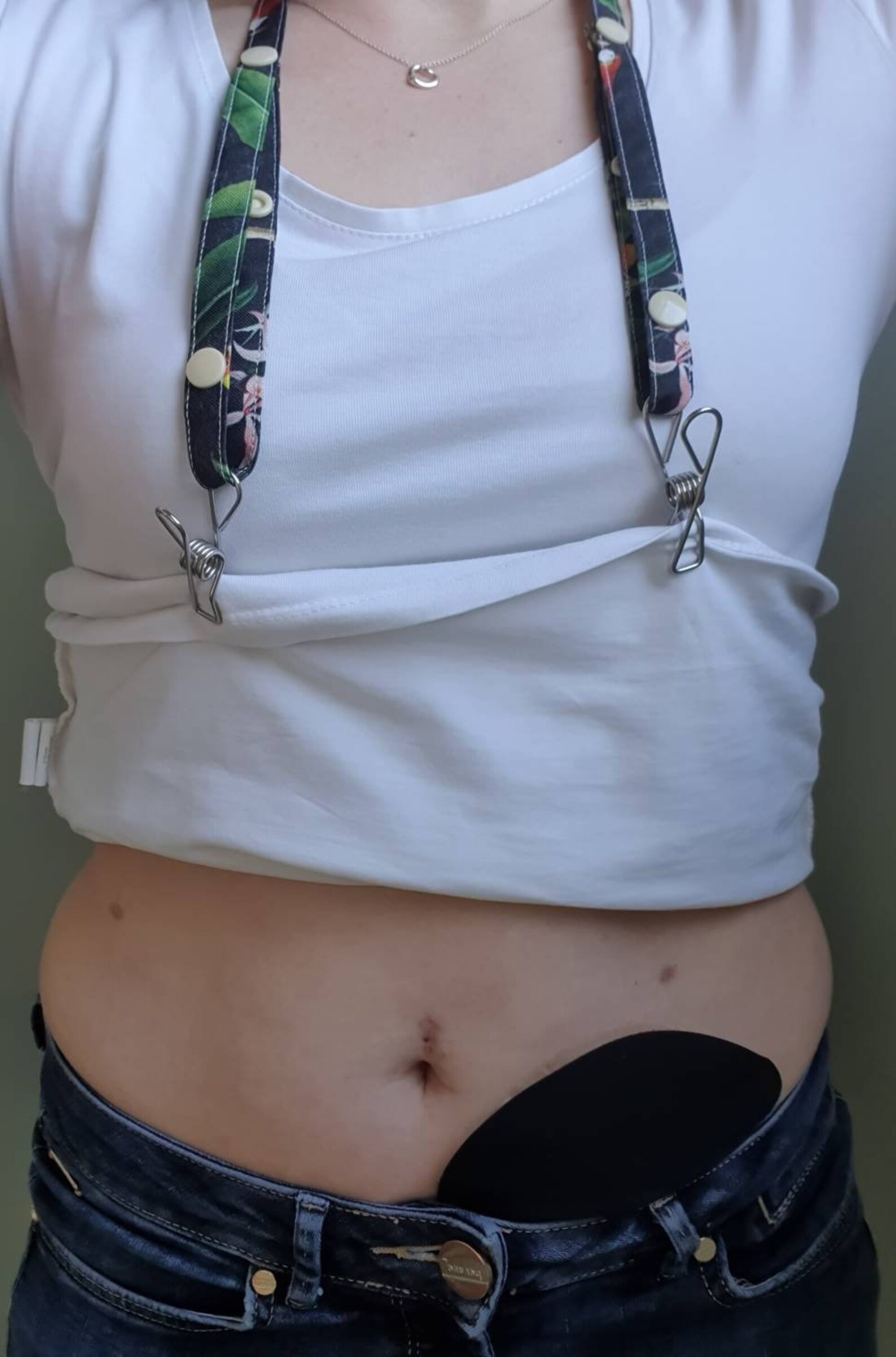 Stoma Accessories Shirt Saver Straps Colostomy Ileostomy Etsy