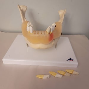 Puede incluir: Un modelo dental de una mandíbula inferior con una dentadura postiza parcial. El modelo está hecho de plástico blanco y tiene una línea de encía rosa. La dentadura postiza está hecha de plástico transparente y le faltan varios dientes. Hay cinco dientes sueltos sobre una superficie blanca.