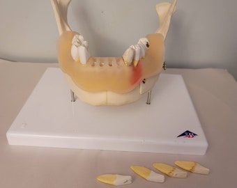 Puede incluir: Un modelo dental de una mandíbula inferior con una dentadura postiza parcial. El modelo está hecho de plástico blanco y tiene una línea de encía rosa. La dentadura postiza está hecha de plástico transparente y le faltan varios dientes. Hay cinco dientes sueltos sobre una superficie blanca.