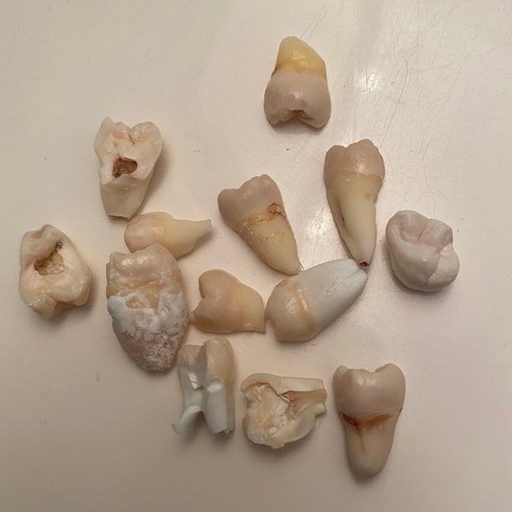 10+ CRACKED AND BROKEN Real Human Teeth - Molars, Premolars, & Anteriors