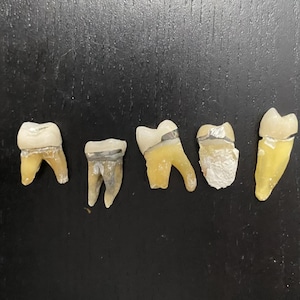 5 Real Human Teeth WITH CROWNS