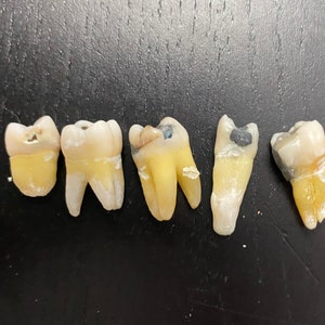 5 Real Human Teeth With DENTAL AMALGAM FILLINGS