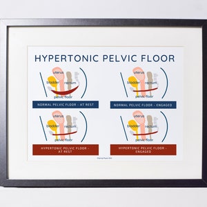 Hypertonischer Beckenboden Poster | Physiotherapie Diagramm (Digitaler Download)