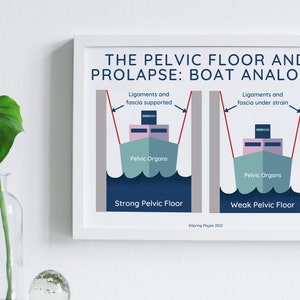 Pelvic Floor Physical Therapist Poster | Pelvic Floor and Prolapse | Pelvic Floor Physical Therapy