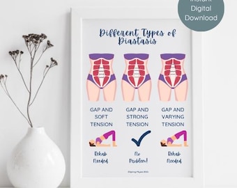 Diastasis Types Poster | Pelvic Floor, Core Anatomy (Digital Download)