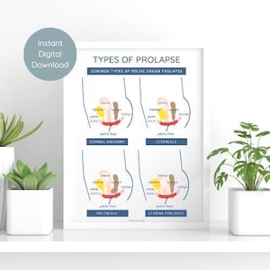 Beckenboden Organ Prolaps Anatomie Poster | Beckenboden Kunst | (PDF, JPEG)