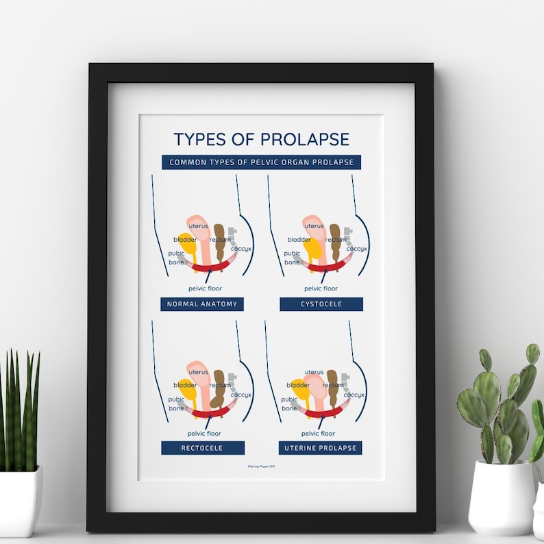 a4-anatomy-poster-pelvic-organ-prolapse-poster-pelvic-floor