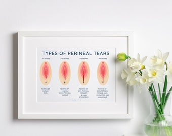 Perineal Tears Education Poster | Midwife Pelvic Health (Digital Download)