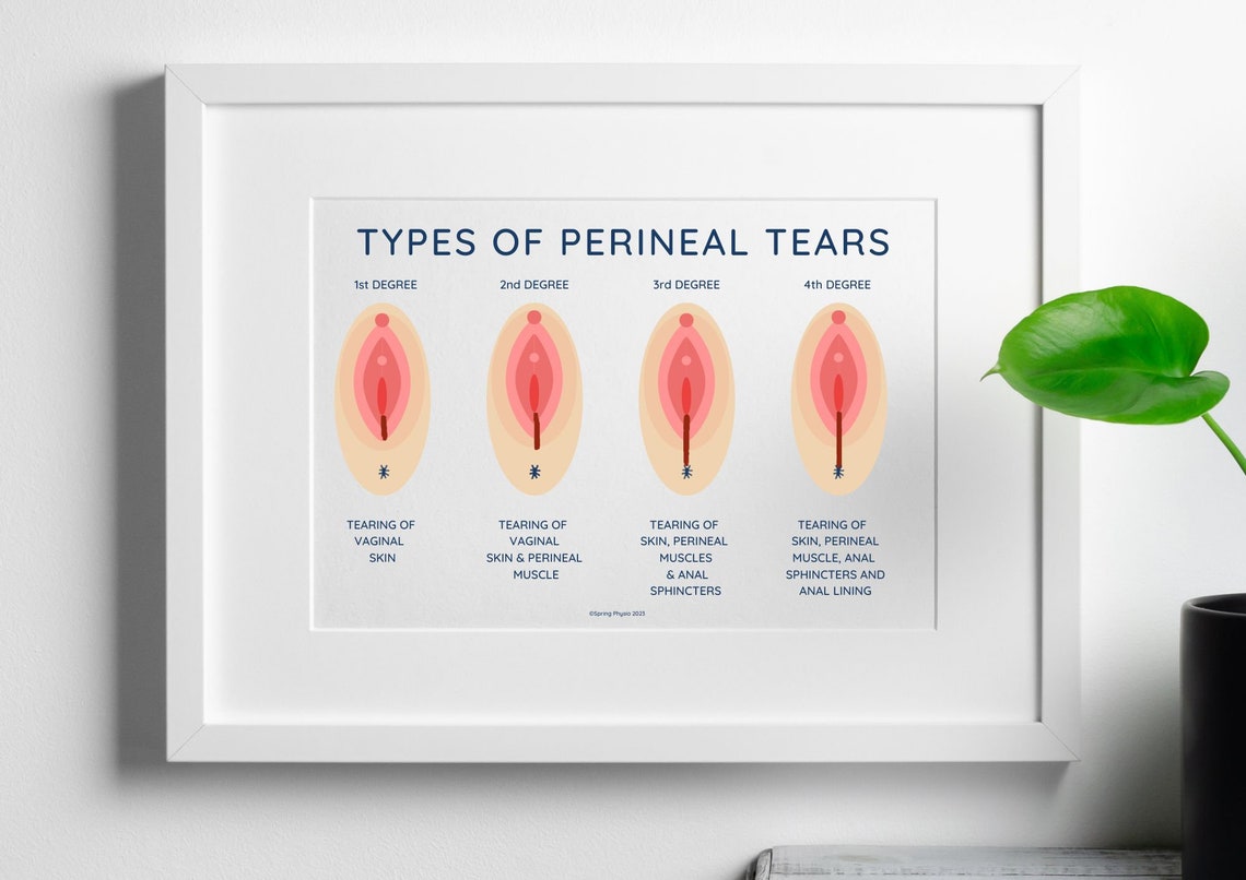 Birth Education Poster Perineal Tears Midwife Education Etsy UK