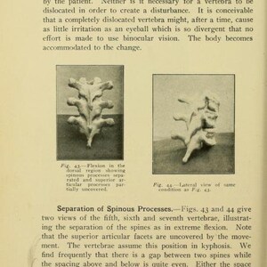 May include: Two black and white anatomical illustrations of the human spine. The first image shows the spine in a flexed position, while the second image shows the spine in a lateral view. The images are labeled "Fig. 43" and "Fig. 44" respectively. The text "Separation of Spinous Processes" is also visible.