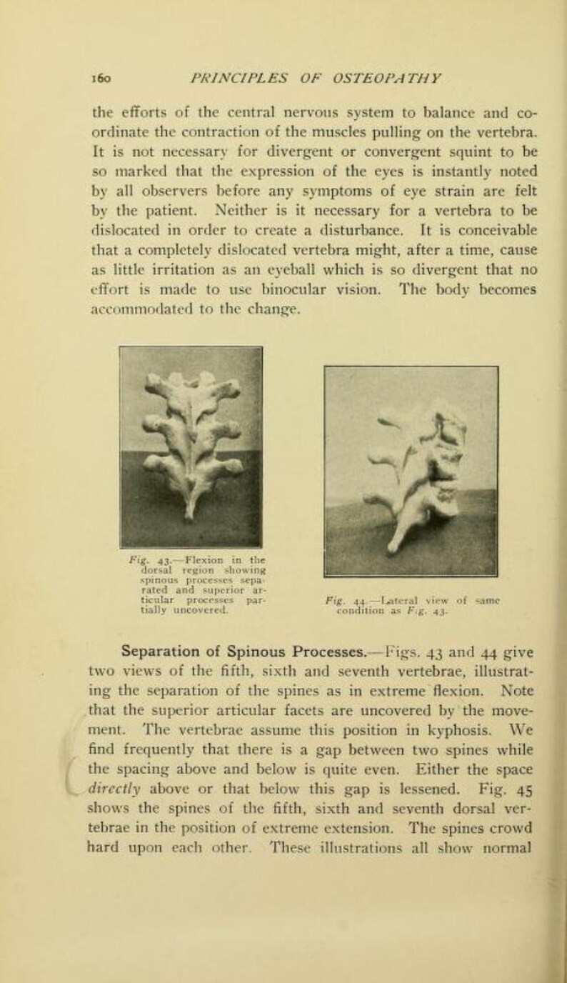 May include: Two black and white anatomical illustrations of the human spine. The first image shows the spine in a flexed position, while the second image shows the spine in a lateral view. The images are labeled "Fig. 43" and "Fig. 44" respectively. The text "Separation of Spinous Processes" is also visible.