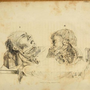 May include: A black and white anatomical illustration of the muscles of the head and neck. The illustration shows two views of the head, one from the front and one from the side. The muscles are labeled with numbers.