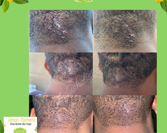 Razor Bumps Etsy
