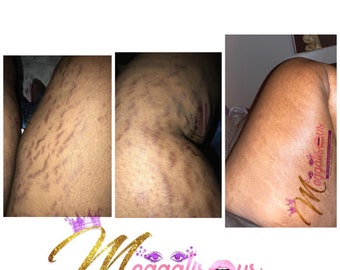 Customized natural stretch mark skin burst eczema cellulite cream