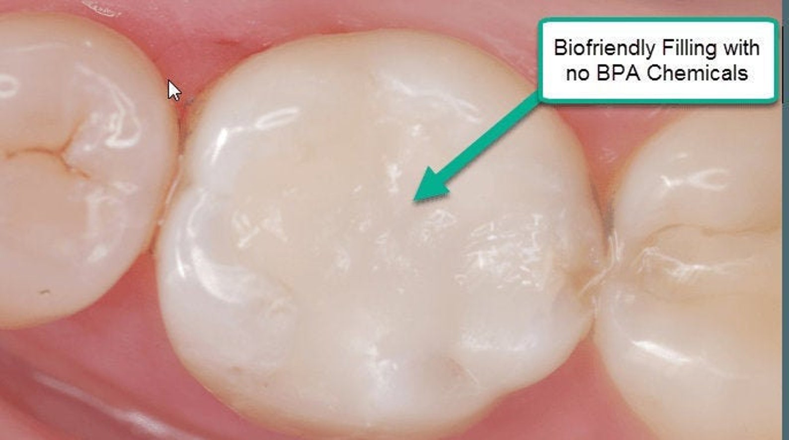 Permanent Dental Repair Kit