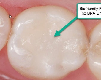 Chipped Tooth Filling Kit DIY Fix, Broken Teeth Emergency Repair Crafting Kit, Composite Filling (not a medical device)