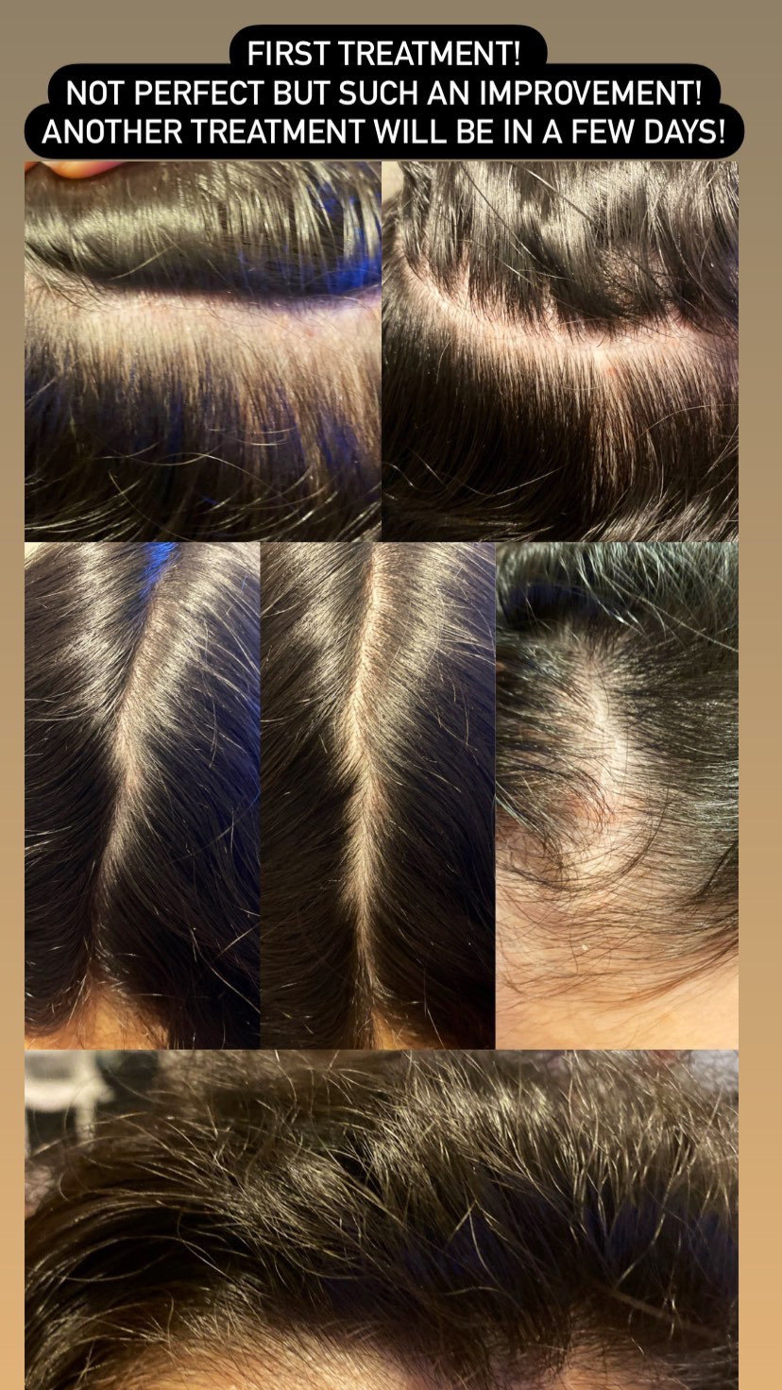 Scalp Exfoliation Etsy