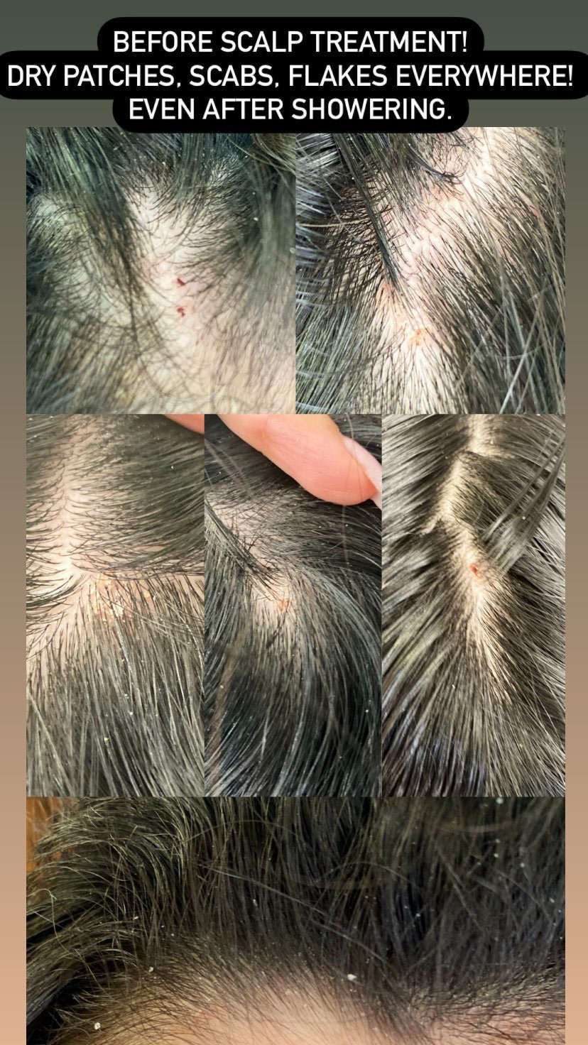 Scalp Exfoliation Etsy