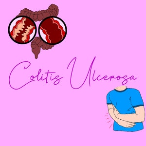 Colitis ulcerosa