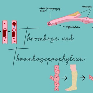 Könnte beinhalten: Eine medizinische Illustration, die den Prozess der Blutgerinnung, oder Thrombose, und die Vorbeugung von Blutgerinnseln, oder Thromboseprophylaxe, darstellt. Das erste Bild zeigt Blutkörperchen, die normal durch ein Blutgefäß fließen. Das zweite Bild zeigt Blutkörperchen, die sich zusammenballen und einen Thrombus bilden. Das dritte Bild zeigt einen Thrombus, der das Blutgefäß blockiert. Das vierte Bild zeigt ein Bein mit einem Thrombus in der Vene. Das fünfte Bild zeigt ein Bein mit einem Kompressionsstrumpf. Das sechste Bild zeigt ein Bein mit einem Thrombus in der Vene, aber der Thrombus ist kleiner als auf dem vorherigen Bild.