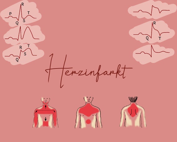 Herzinfarkt