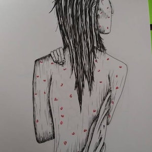 Chicken pox